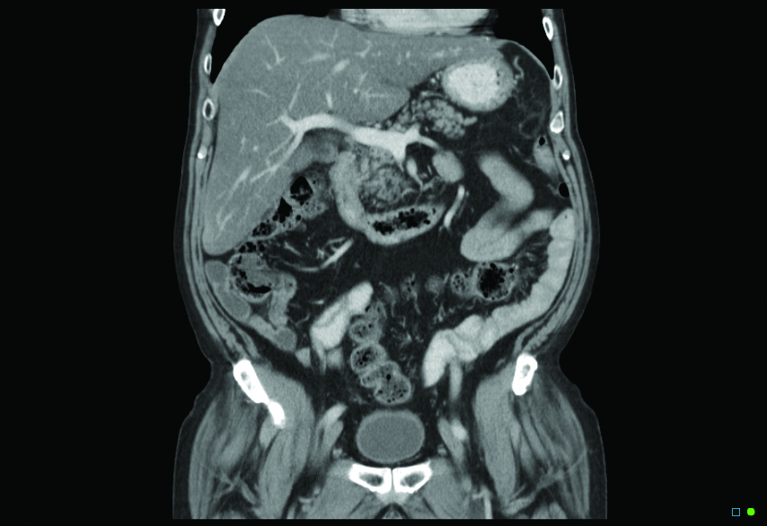 Chest Abdo Pelvis CT 0001