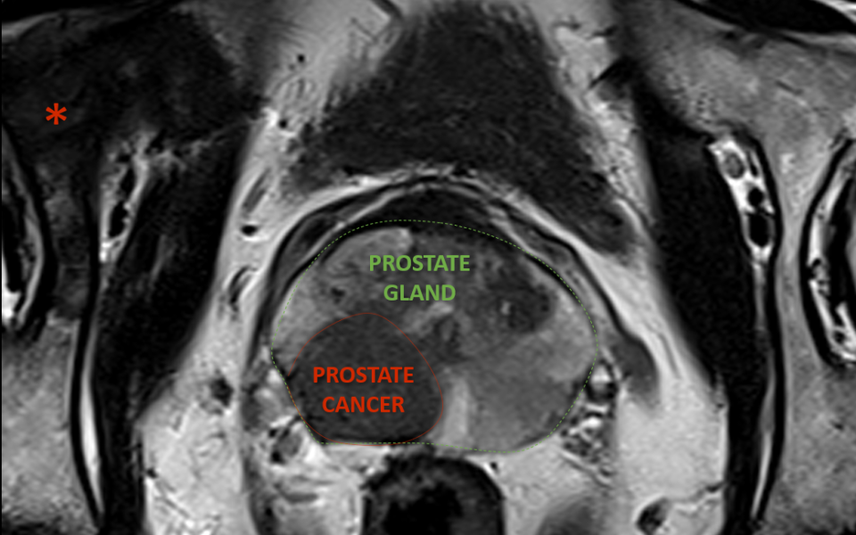 Prostate